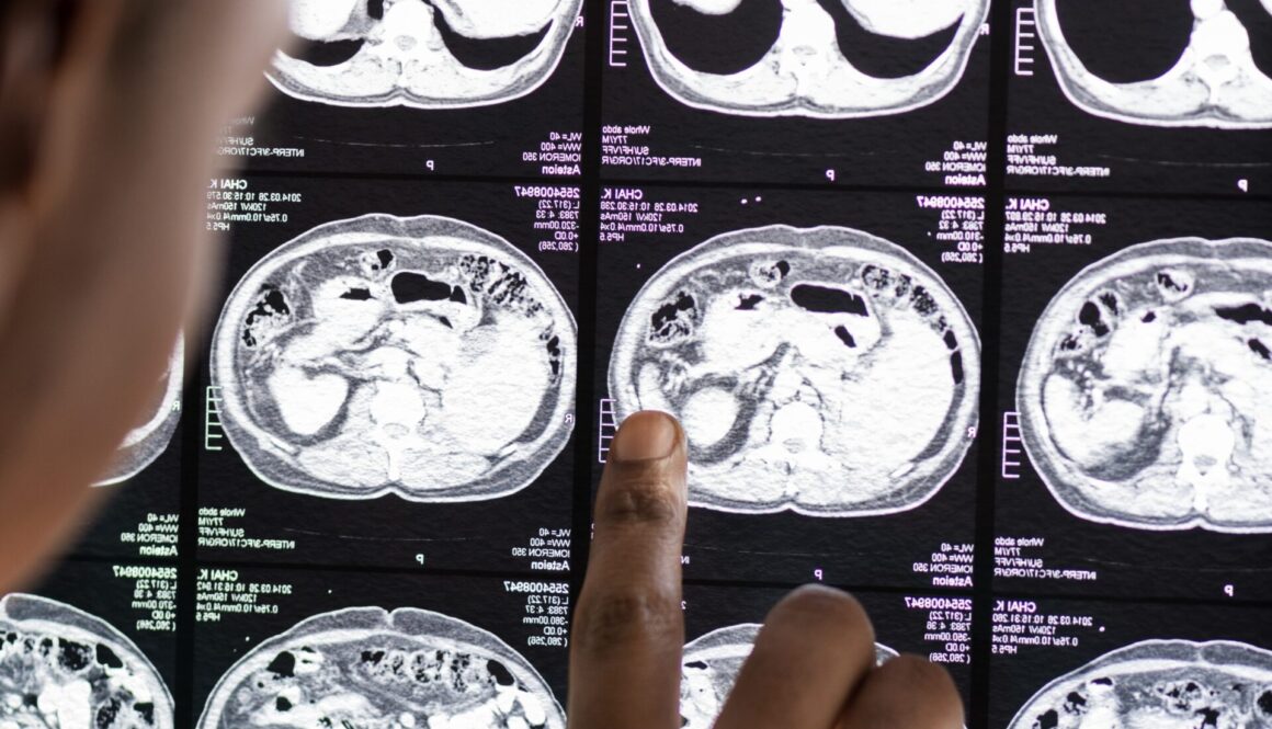 Trombose Cerebral um drama que podemos prevenir e evitar